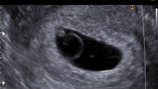 Патология беременности раннего срока (15-2-17)