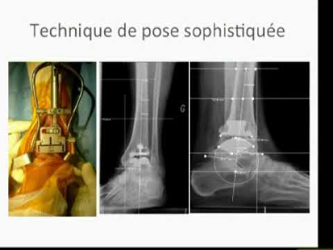 Vidéo: La Calcification Du Cartilage De L'articulation De La Cheville Est Associée à L'arthrose Dans La Population Générale