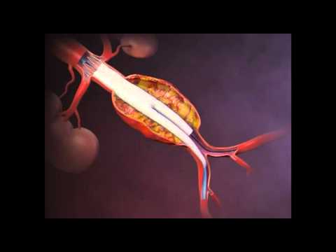 Aneurisma da Aorta Abdominal | AAA | Cirurgia Endovascular