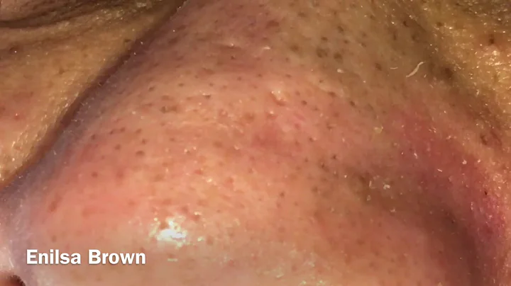 Blackheads Extractions and Acne Treatment on Daryl