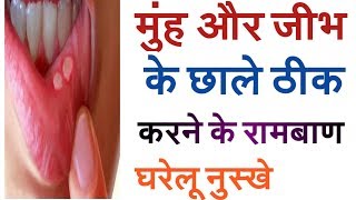 12घंटे में मुंह और जीभ के छाले ठीक करने के लिए घरेलु उपाय | Home Remedy for Mouth & Tongue Ulcers