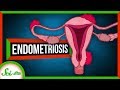 Endometriosis: When Uterine Tissue Goes Rogue