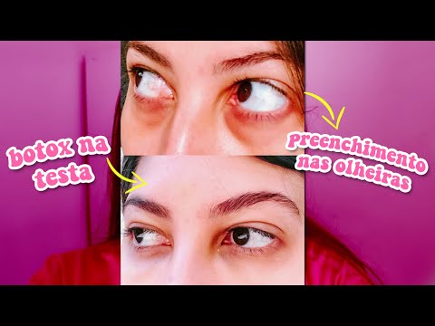 TUDO SOBRE MEU PREENCHIMENTO E BOTOX | Gabriela Gouveia