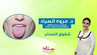 Setaat.com شقوق اللسان مع د.مروه الصياد