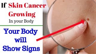 Kanser 9 Na Palatandaan O Senyales Ni Dr Willie Ong