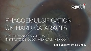 Surgery Video: Phacoemulsification on hard cataracts by Fernando Aguilera
