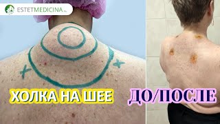 Холка на шее: как избавиться. Vaser Lipo. Ультразвуковая липосакция