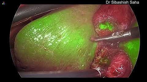 Laparoscopic Subtotal Cholecystectomy in Frozen Calot