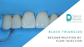 Black triangles  - reconstruction by flow injection 🦷