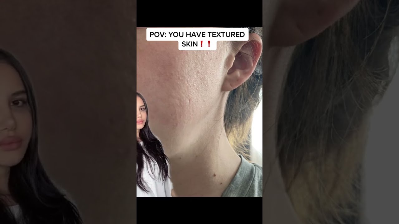 Do You Have TEXTURED SKIN 