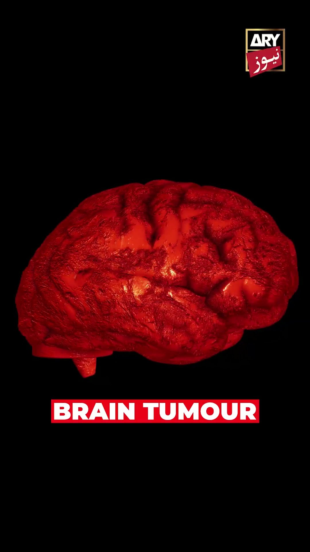 #BrainSurgery #Anesthesia #Neurosurgery #BrainTumor #shorts