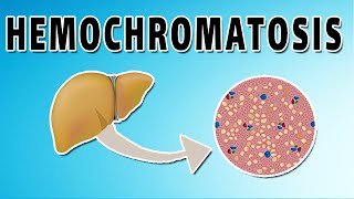 Hemochromatosis