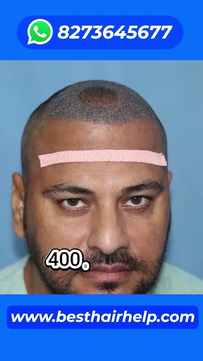 4000-grafts-hair-transplant-cost-in-india-hairtransplantcost-youtube
