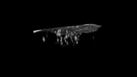 3D Reconstruction of Plaques Under Surface of the Brain
