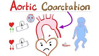 Coarctation of the Aorta | Cardiology Series | Types, Symptoms, Signs, Diagnosis & Treatment