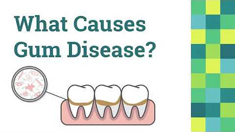 Gum Disease Treatment in Granbury: Dr. Bruce Baird...