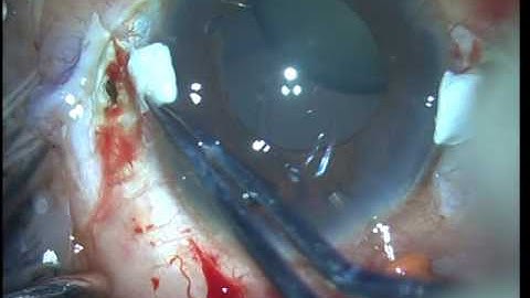 Glued IOL scaffold with Lensectomy Soosan Jacob with audio 2 45 min