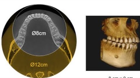 3D imaging vs 2d imaging. Why CBCT is better than IOPA or X ray ?