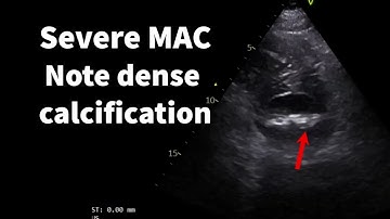 How to grade mitral annular calcification (MAC)
