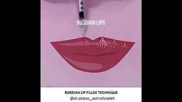 Russian Lip Filler Technique Russian Lips Style Filler In Dubai Russianlip Lipfiller 