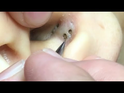 Safe Ear Acne Treatment-安全な耳のにきび治療