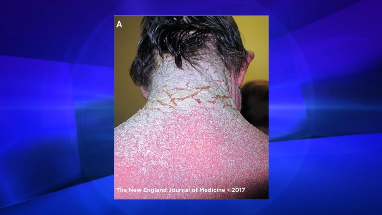 Could This Happen to You? Crusted Scabies The Doctors
