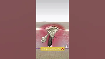 يمنع نمو الشعر تحت الجلد Foryoupage Shaving Kinseibeautylaser Foryou E3 Foryou 