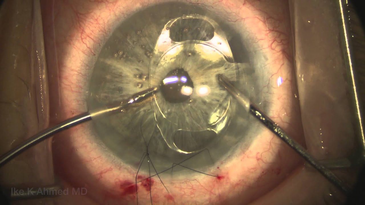 Secondary Intraocular Lens (IOL) Implantation - EyeWiki