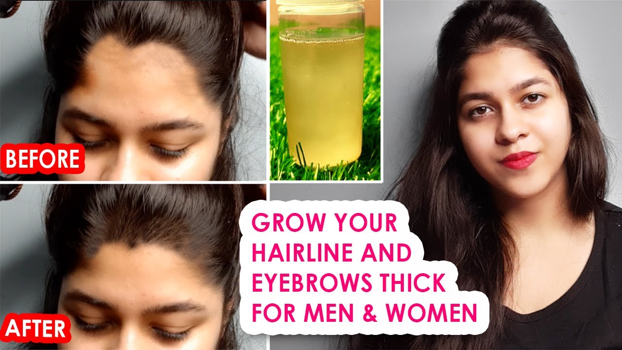 Grow Your Hairline Back In 7 Days 