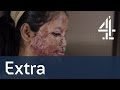 Acid Attack: The Girl Who Lost Her Face | Unreported World Shorts