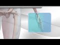 Thumb UCL Repair With InternalBrace™ Ligament Augmentation Procedure