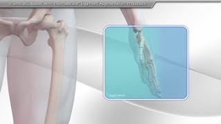 Thumb UCL Repair With InternalBrace™ Ligament Augmentation Procedure
