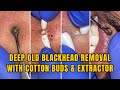 Deep old blackhead removal with cotton buds  extractor  drlalit kasana 