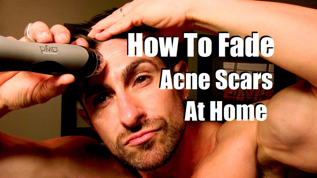 How To Fade Acne Scars Reduce Breakouts Even Skin Tone At Home