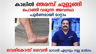 കാലിൽ ഞരമ്പ് തടിച്ചു പൊങ്ങി വരുന്ന അവസ്ഥ പൂർണമായി മാറ്റാം | varicose vein | Dr. Vineeth Kumar