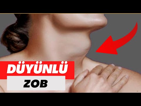 Düyünlü Zob - Müalicə ilə sağalır?