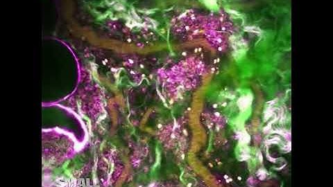 White Blood Cell Swarming Near Tumor Site | 2018 #NikonSmallWorld #Microscopy