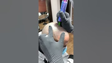 Best scalp micropigmentation reaction