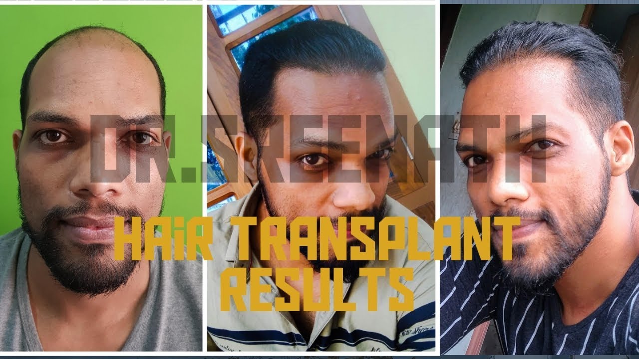 Hair O Dent  FUE Hair Transplant  Kochi  Calicut  Kochi