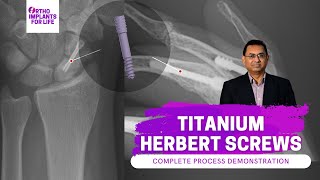 Titanium Herbert Screw Fixation Procedure