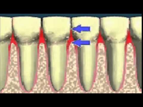 Déchaussement et perte des dents à cause de la maladie parodontale