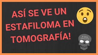 👁ESTAFILOMA posterior [EN TOMOGRAFIA computarizada]