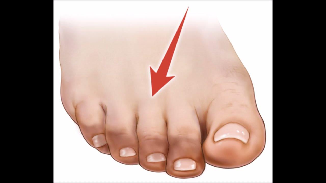 Красивые мужские пальцы ног. Красивые пальцы ног. Вальгусная деформация первого пальца стопы 2 степени. Форма пальцев на ногах. Почему не чувствуешь пальцы на ногах.