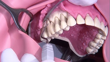 Periodontal surgery (Modified Widmann flap)