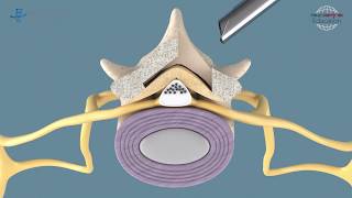 Spinal Stenosis  Fullendoscopic decompression at the lumbar spine with VERTEBRIS stenosis