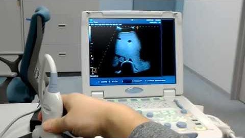 HoloLens ver. of AR Echography System Based on Markerless Probe Tracking