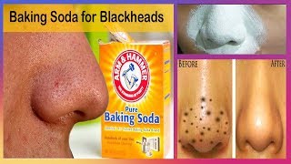 5 Mins Remedy for Blackheads / Whiteheads | Miracle Baking Soda Recipe