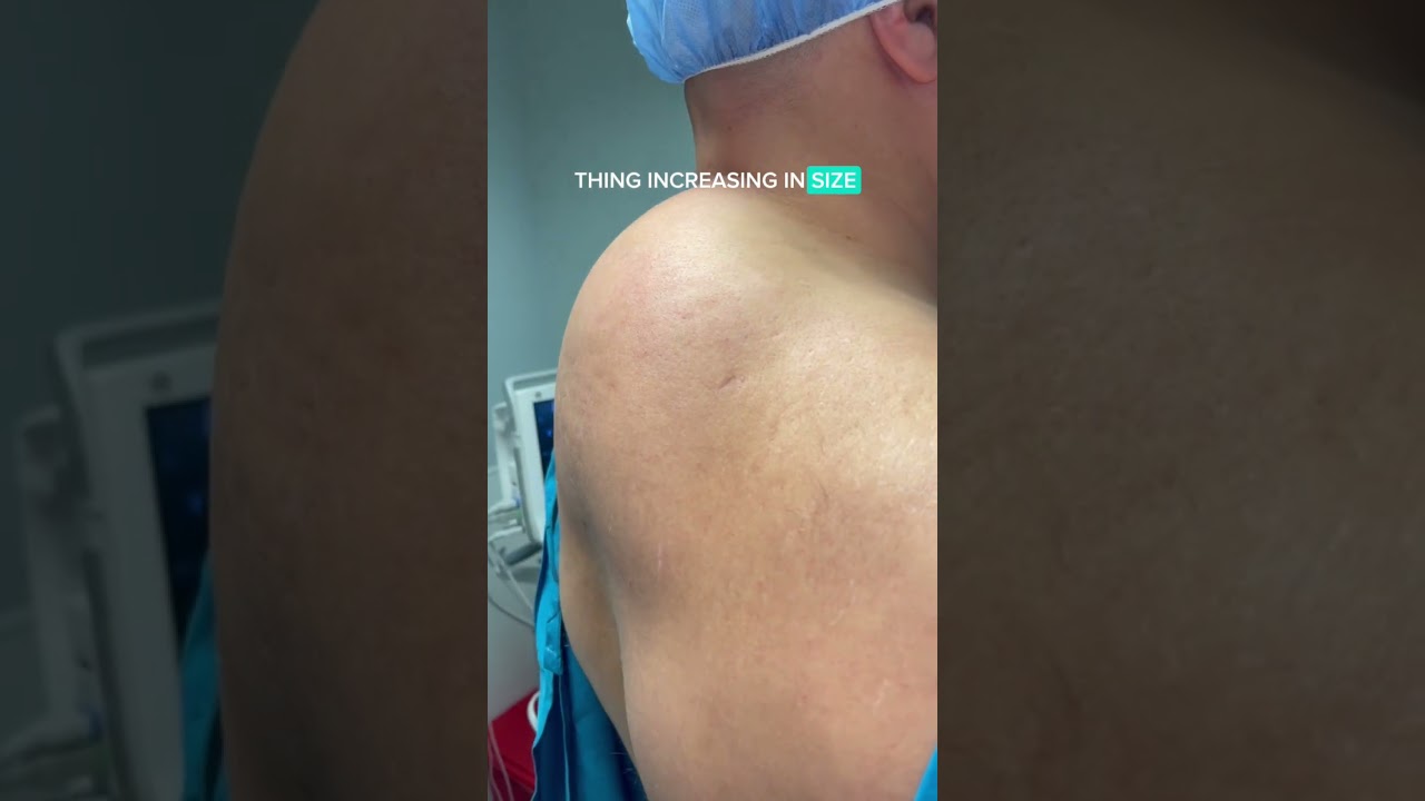 GIANT LIPOMA REMOVAL - DR. TANVEER JANJUA- NEW JERSEY