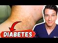 Hidden Signs You May Have Diabetes (Most People Miss them)