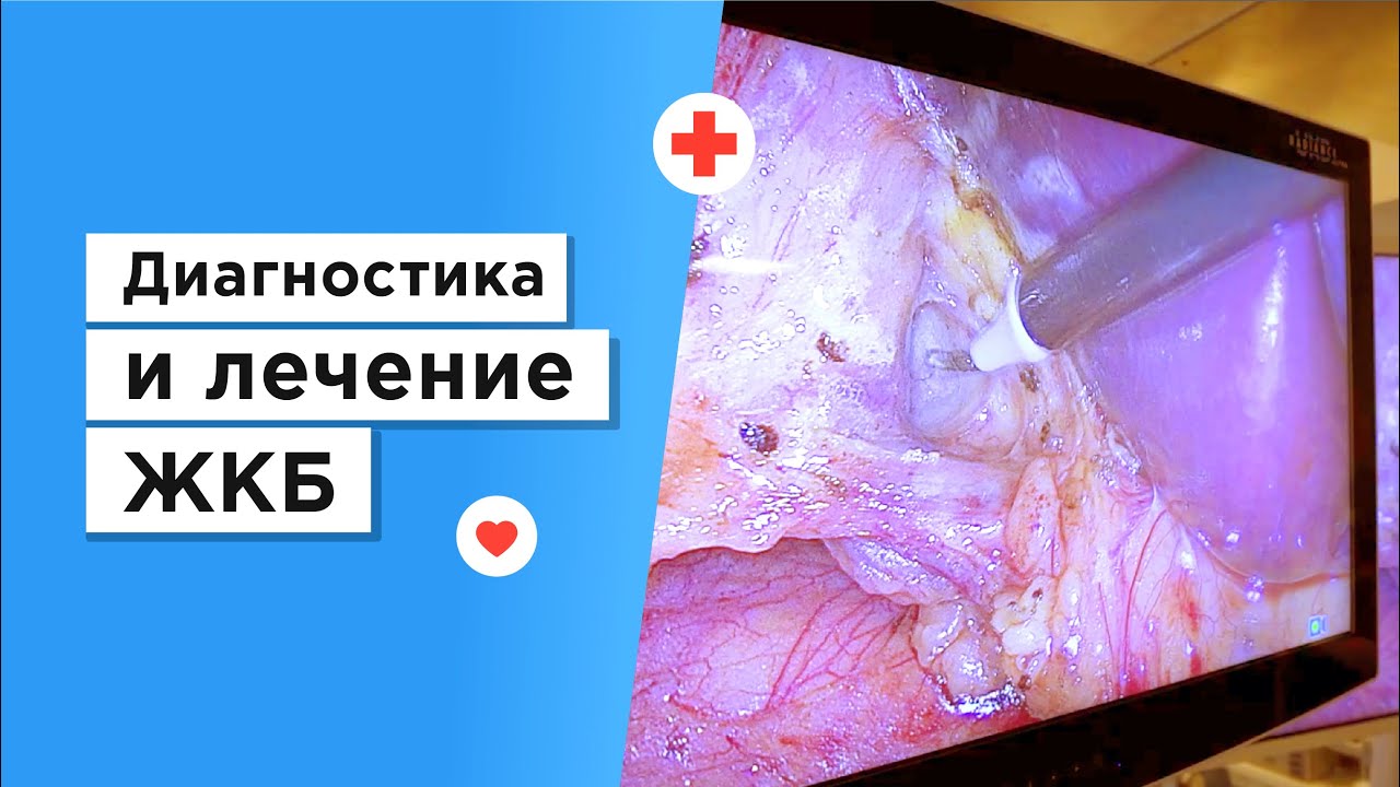 Диагностика и лечение желчнокаменной болезни (ЖКБ)